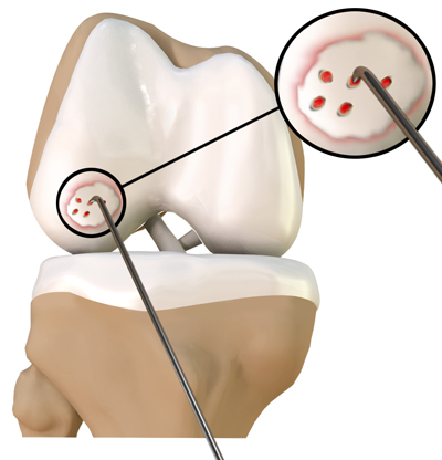 Chondroplasty