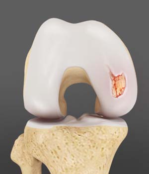 Chondral or Articular Cartilage Defects