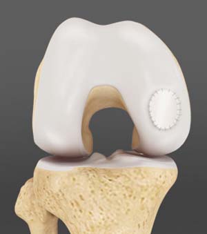 Ligament Injuries