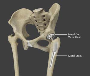 Hip Replacement