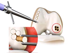 Osteochondral Autograft Transfer System (OATS)