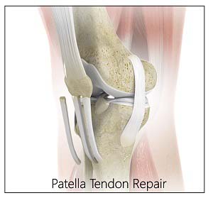 Patellar Tendon Rupture