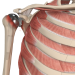 Revision Shoulder Replacement