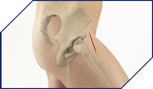 Direct Anterior Approach Total Hip Replacement