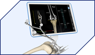 Computer Navigated Knee Replacement